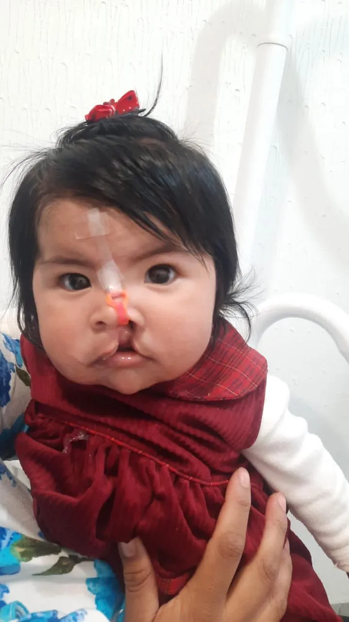 Mia antes de su cirugía de labio hendido