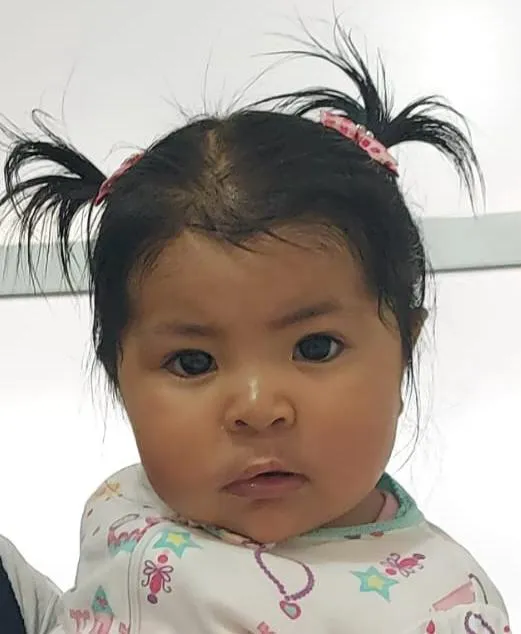 Mia sonriendo después de su cirugía de labio hendido